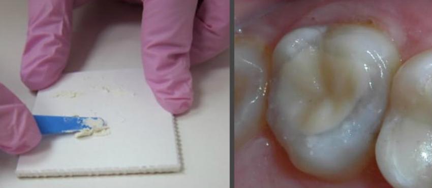 Изобретена вечная пломба, которая защищает зуб от кариеса