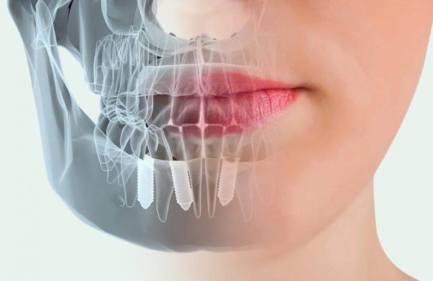 Что изменилось в стоматологической имплантологии