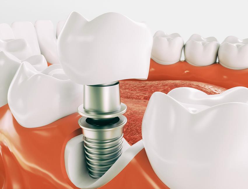 Имплантация зубов на Преображенке