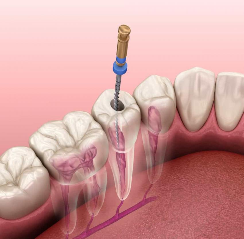 Терапия корневого канала или удаление зубов