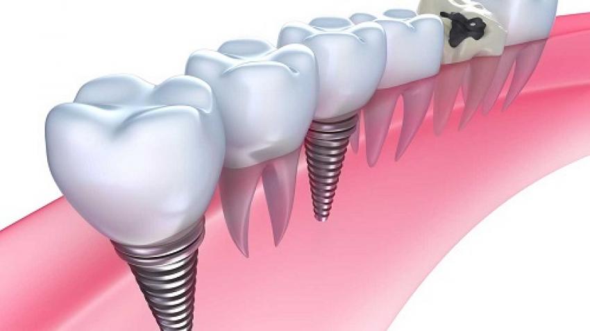 Разница между зубными протезами и имплантатами