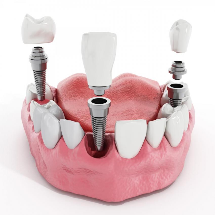 Что такое зубные имплантаты?