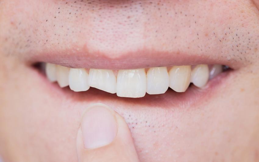 Распространенные виды травм зубов