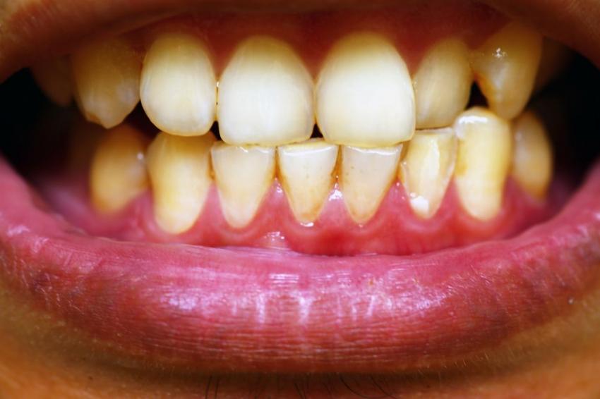 Как избежать появление пятен на зубах
