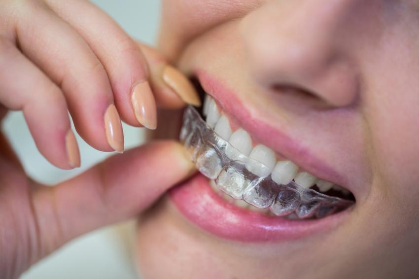 Метод восстановления улыбки Snap-On Smile